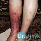 Erysipelas: before and after treatment